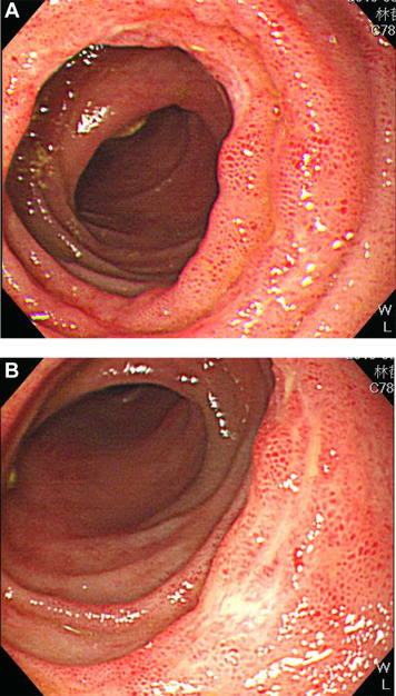 A retrograde single balloon enteroscopy reveals several discrete 0.5–1.5 cm ...