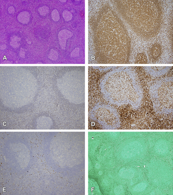 Histopathology of hepatic pseudolymphoma. Hematoxylin–eosin-stained histological ...