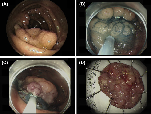 Endoscopic submucosal dissection of a colorectal neoplasm. (A) A large laterally ...