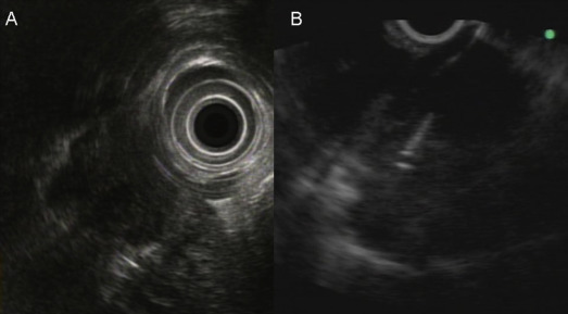 A patient with pancreatic head neuroendocrine tumor and mediastinal lymph node ...