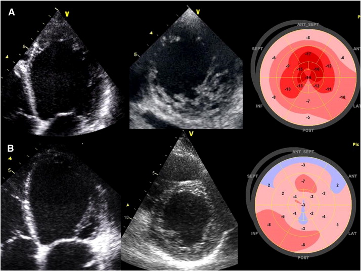 2D Myocardial deformation pattern of a dilated cardiomyopathy and a left ...