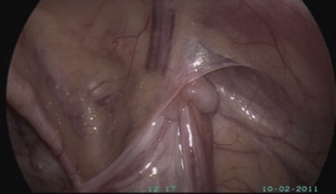 Intra-abdominal testis. The testis is located at the outer ring of the inguinal ...