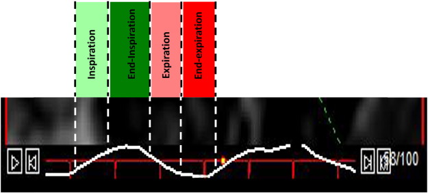 The respiratory cycle is divided into 4 phases: inspiration (light green), ...