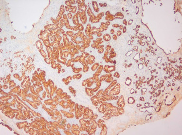 Estudo imunohistoquímico – expressão de citoqueratina 7; (100x).