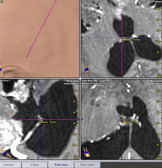 Measurement of the virtual displacement for endoscopic tumor biopsy in ...