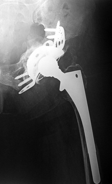 AP radiograph after revision.