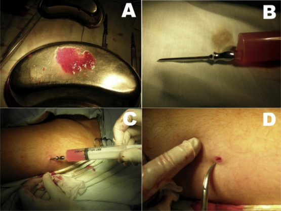 (A) Finely-minced thyroid tissue. (B) Emulsified thyroid tissue in saline, ready ...