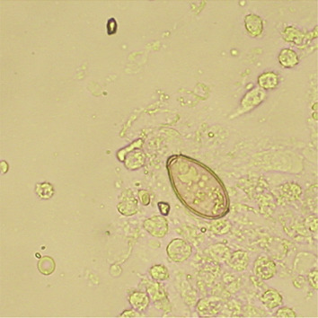 Clonorchis sinensis ova had characteristics of light yellow color, prominent ...