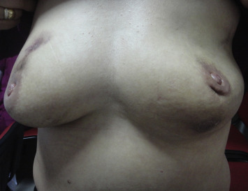 The picture presents the bilateral synchronous involvement in a 34-year-old ...