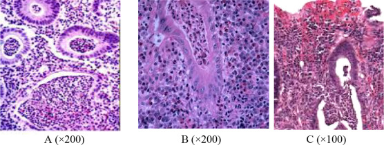 Histopathological grades of ulcerative colitis shows (A) Grade 3, neutrophilic ...