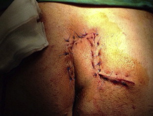 View of classical rhomboid flap.