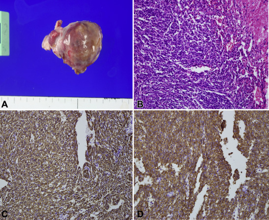 Pathological findings. (A) Gross finding shows a 3.6 × 3.0 × 1.8 cm mass. (B) ...