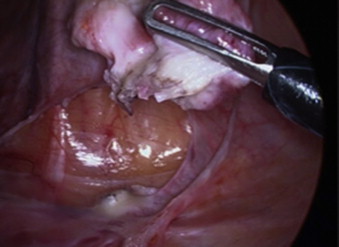 Imagem intraoperatória da exérese de schwannoma retroperitoneal (3,5×3,1×2,8cm).