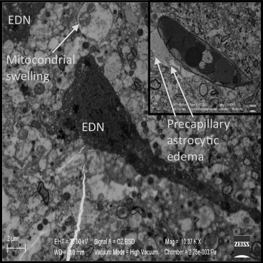Irreversible damage in the glial cells, neurons, and precapillary astrocytes, ...