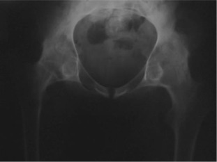 Pre-operative x-ray of a patient with bony ankylosis.