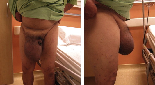 Large incarcerated scrotal hernia—anterior and lateral views.