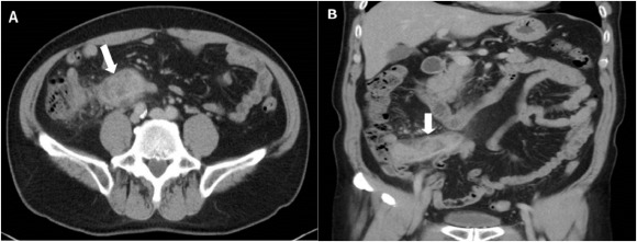 Computed tomography images: (A) cross section of abdominal computed tomography ...
