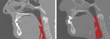 Imagen médica sagital a) sin aparato bucal, b) con aparato bucal.