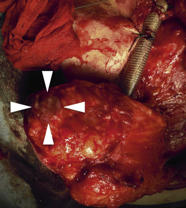 Prefabricated skin graft was de-epithelialized for 2.5 cm in diameter.