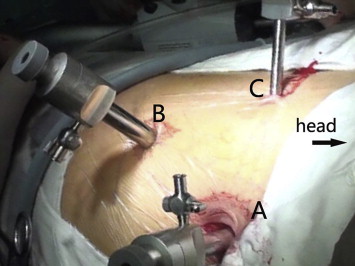 Trocar sites. Trocar A was located in the posterior axillary line 2 cm below the ...