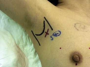 Position of the patient with arm abduction from the chest wall of around 105°, ...