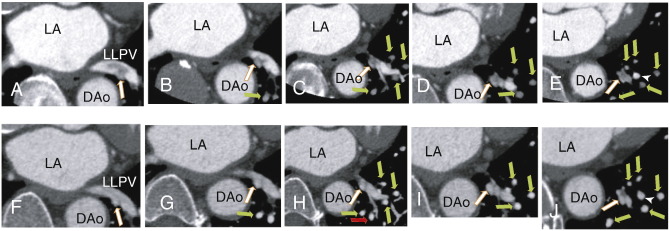 An axial image demonstrating A: A thrombus in the left lower pulmonary vein ...