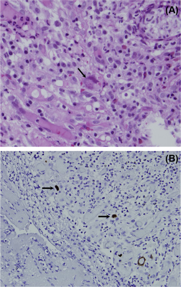 The typical cytomegalovirus (CMV) inclusions are seen in stromal cytomegalic ...