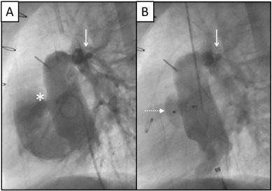 Fenestration closure device in a patient who had undergone previous angioplasty ...