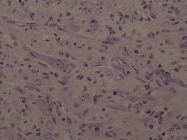 Photomicrograph showing a conspicuous admixture of lymphocytes and plasma cells ...