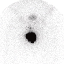 Linfocintigrafia do doente com BDGS falsamente negativa. Seta: gânglio sentinela ...