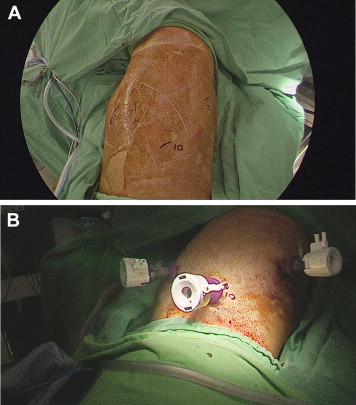 (A)The position of the port-wound in the left chest wall is marked. All three ...