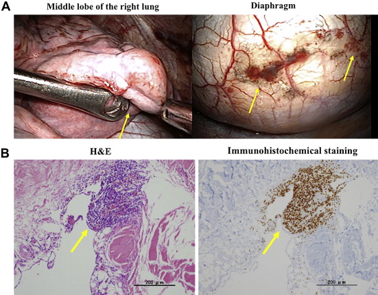 (A) The intraoperative findings of diaphragmatic endometriosis. (B) A focus of ...