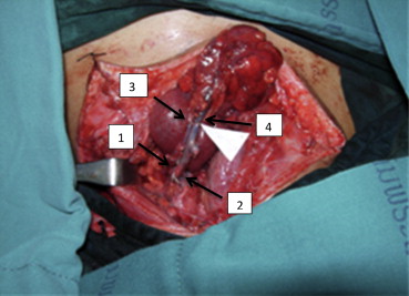 Vascular anastomosis. Donor vessels: (1) transverse cervical artery; (2) ...