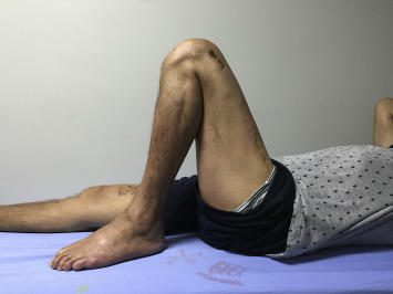 ROM at the final follow-up.