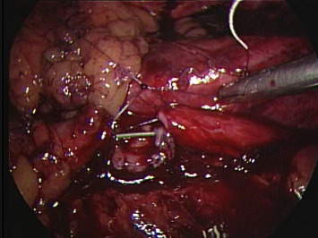 Reanastomosis was performed with a running suture.