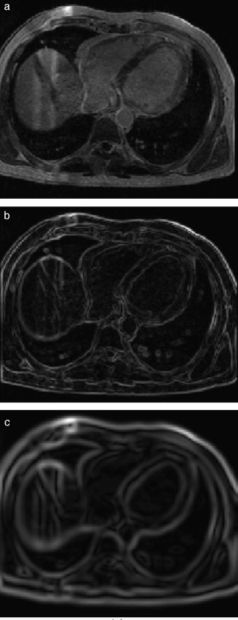Aplicación de las rutinas de módulo de una imagen gradiente. (a) IRM ...