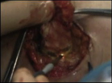 Along with the demarcation line, the mammary duct segment was dissected.