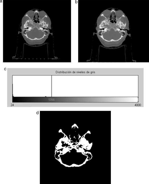 Técnica de umbralización aplicada a TC. (a) Vista original de un corte axial de ...