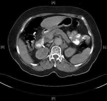Focal wall thickening in the second portion of the duodenum (white arrow).