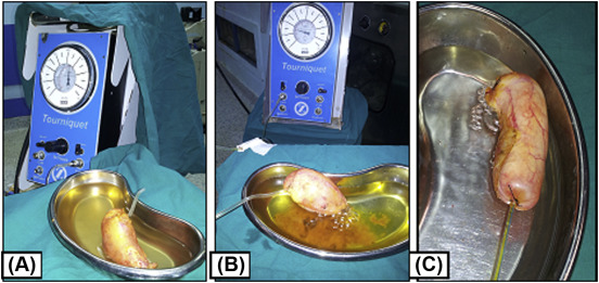(A) Cystic duct sealed with harmonic scalpel just before leakage resisting ...