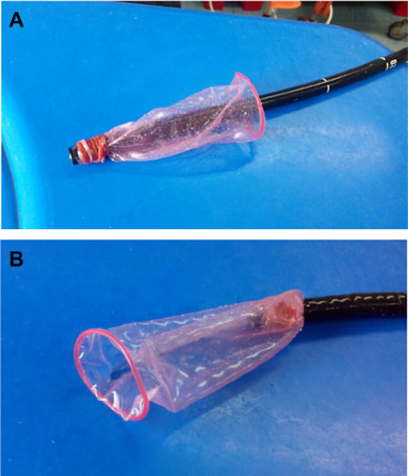 (A) A condom was fastened to the scope end with a rubber band to act as a ...