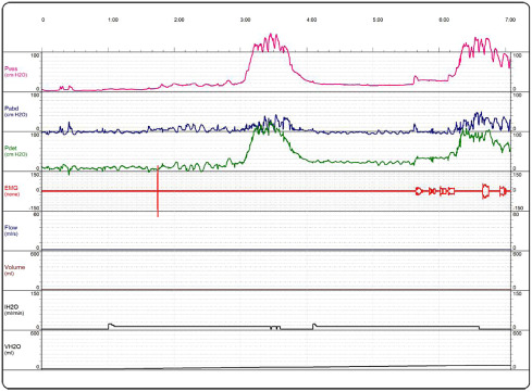 Exame urodinâmico de um doente com NLUTD antes do tratamento com BTX‐A.