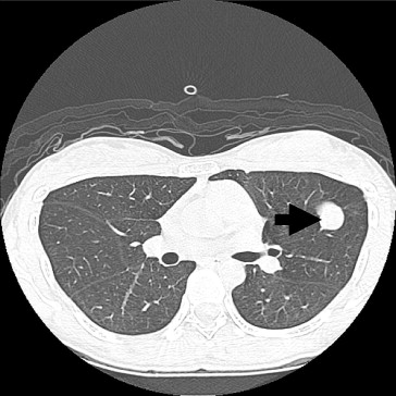 Computed tomography showed a well-defined nodule, 7mm in size, over the upper ...