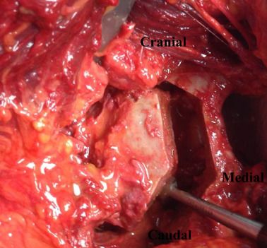 Appearance of all the osteotomies, from the interior of the pelvis.