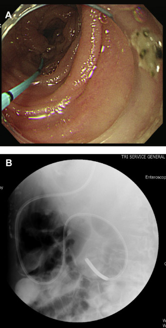 (A) A guide wire is placed into the jejunum. (B) A 12-Fr feeding tube is ...