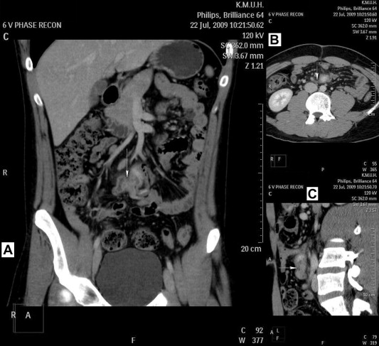 Fistula (arrow) of Meckel diverticulum and apex of appendix; (A) coronal view; ...