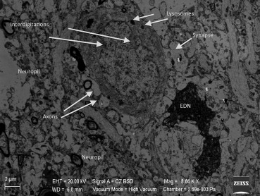 Interdigitations in the neuron nucleus and a noticeable increase in the amount ...