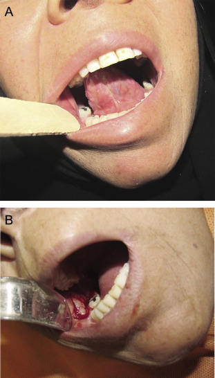 (A) Obliteration of the mandibular vestibule. (B) Alloderm is used for covering ...