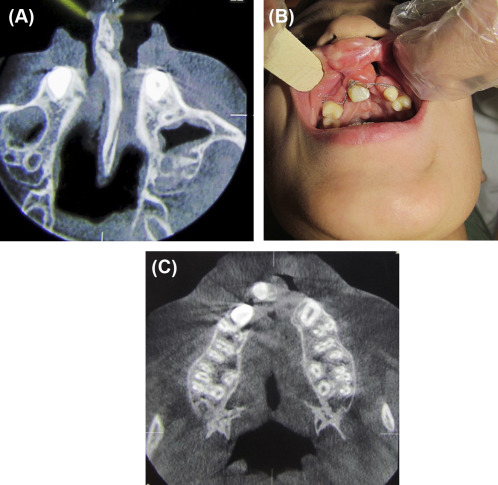 (A) Protruded premaxilla and thick bony septum. (B) Clinical result 1 month ...