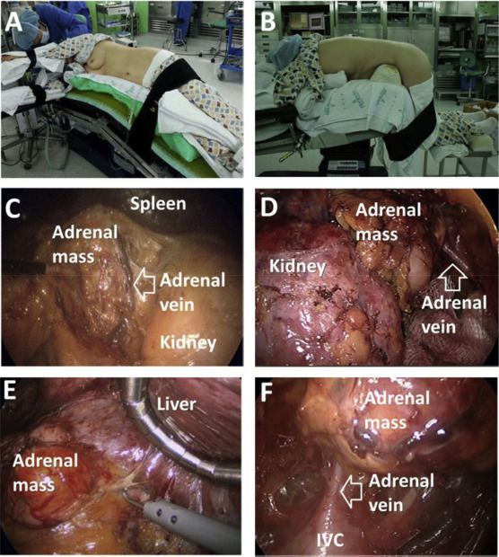 (A) Position for left lateral transperitoneal adrenalectomy. (B) Position for ...